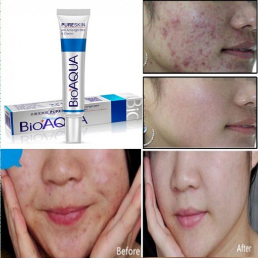 Bio Aqua Acne Removal Cream in Pakistan